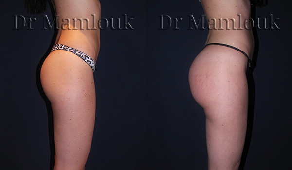 Lipofilling des fesses par injection de 500 ml chez une femme mesurant 1,65m pour 52 Kg réalisé par le Docteur Mamlouk.