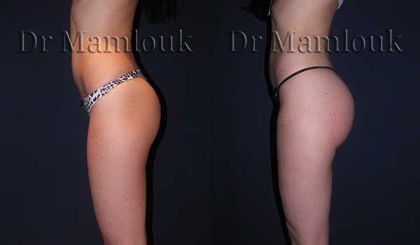 Lipofilling des fesses par injection de 500 ml chez une femme mesurant 1,65m pour 52 Kg réalisé par le Docteur Mamlouk.