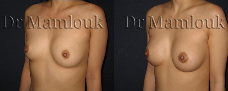 Augmentation mammaire par voie aréolaire de prothèses rondes à profil modéré de 210 cc en position pré-musculaire  - Docteur Mamlouk