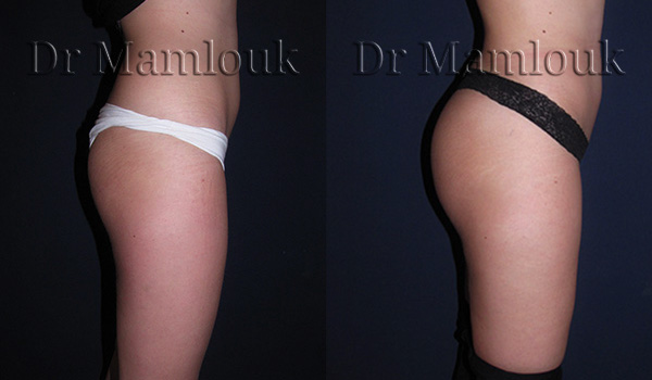 Lipofilling des fesses par injection de 800 ml chez une femme mesurant 1,70m pour 65Kg.