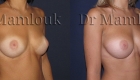 Augmentation mammaire par voie sous mammaire de prothèses rondes à profil modéré de 260 cc en position pré-musculaire - Docteur Mamlouk