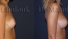 Augmentation mammaire par voie sous mammaire de prothèses rondes à profil modéré de 260 cc en position pré-musculaire - Docteur Mamlouk