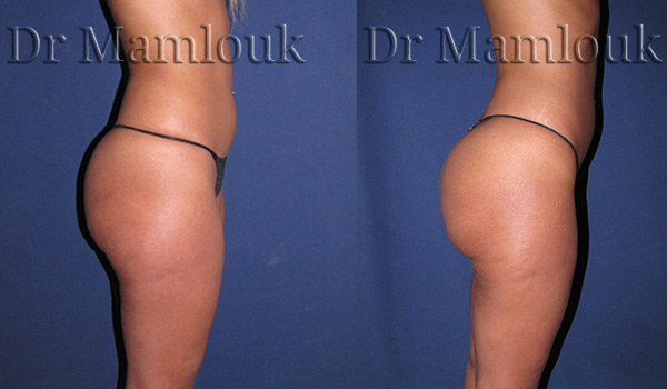 Lipofilling des fesses par injection de 500 ml chez une femme mesurant 1,65m pour 56Kg.