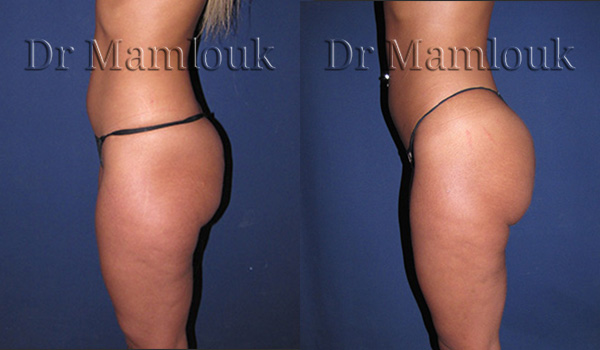 Lipofilling des fesses par injection de 500 ml chez une femme mesurant 1,65m pour 56Kg.