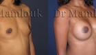 Augmentation mammaire par pose de prothèses rondes de 300 gr par voie aréolaire en position rétro-musculaire.
