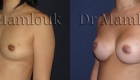 Augmentation mammaire par pose de prothèses rondes de 300 gr à profil modéré par voie aréolaire avec la technique de Dual Plan.