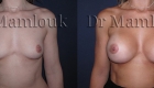 Augmentation mammaire par voie aréolaire, prothèses de 350 gr en position rétro-musculaire en utilisant la technique de Dual Plan.