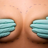 protheses mammaires - Docteur Mamlouk