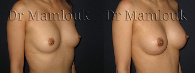 Augmentation mammaire par voie aréolaire de prothèses rondes à profil modéré de 210 cc en position pré-musculaire  - Docteur Mamlouk