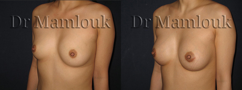 Augmentation mammaire par voie aréolaire de prothèses rondes à profil modéré de 210 cc en position pré-musculaire  - Docteur Mamlouk