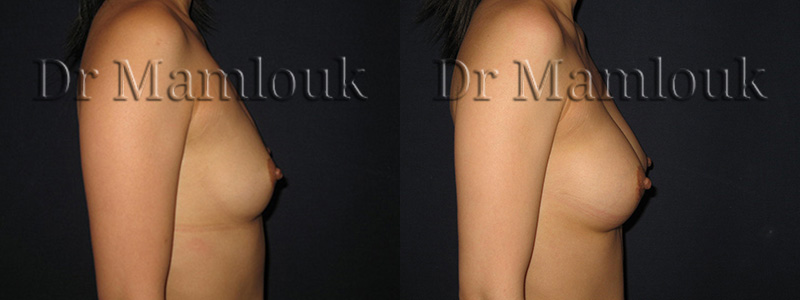 Augmentation mammaire par voie aréolaire de prothèses rondes à profil modéré de 210 cc en position pré-musculaire  - Docteur Mamlouk