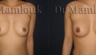 Augmentation mammaire par voie aréolaire de prothèses rondes à profil modéré de 210 cc en position pré-musculaire  - Docteur Mamlouk