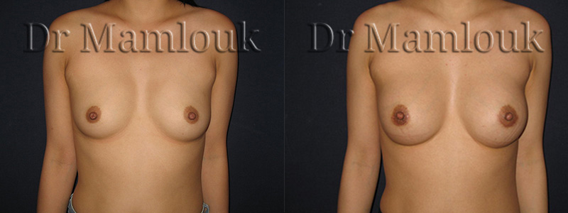 Augmentation mammaire par voie aréolaire de prothèses rondes à profil modéré de 210 cc en position pré-musculaire  - Docteur Mamlouk