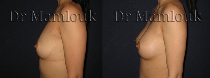 Augmentation mammaire par voie aréolaire de prothèses rondes à profil modéré de 210 cc en position pré-musculaire  - Docteur Mamlouk
