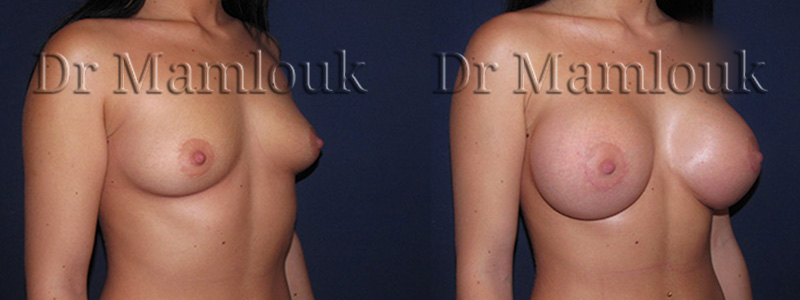 Augmentation mammaire par pose de prothèses rondes à profil haut de 415 cc à droite et 450 cc à gauche par voie aréolaire en utilisant la technique de Dual Plan.