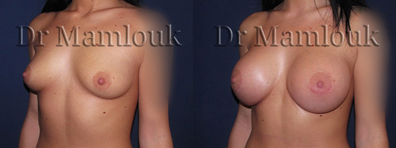 Augmentation mammaire par pose de prothèses rondes à profil haut de 415 cc à droite et 450 cc à gauche par voie aréolaire en utilisant la technique de Dual Plan.