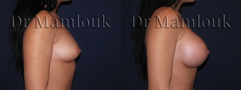 Augmentation mammaire par pose de prothèses rondes à profil haut de 415 cc à droite et 450 cc à gauche par voie aréolaire en utilisant la technique de Dual Plan.