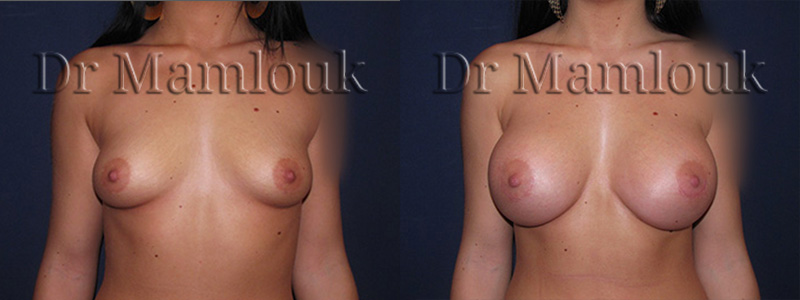 Augmentation mammaire par pose de prothèses rondes à profil haut de 415 cc à droite et 450 cc à gauche par voie aréolaire en utilisant la technique de Dual Plan.