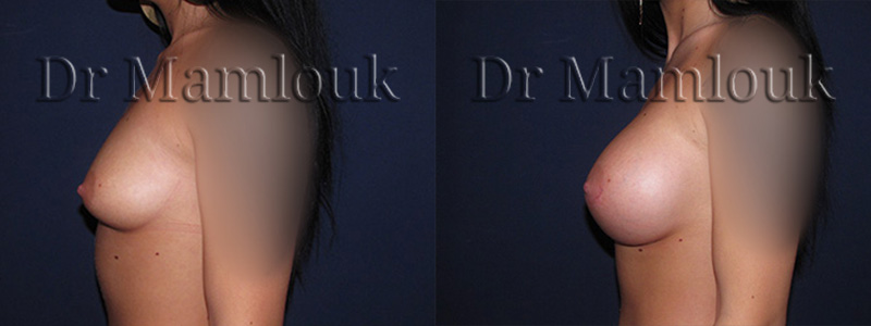 Augmentation mammaire par pose de prothèses rondes à profil haut de 415 cc à droite et 450 cc à gauche par voie aréolaire en utilisant la technique de Dual Plan.