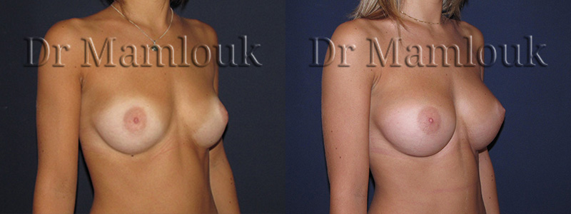 Augmentation mammaire par voie sous mammaire de prothèses rondes à profil modéré de 260 cc en position pré-musculaire - Docteur Mamlouk