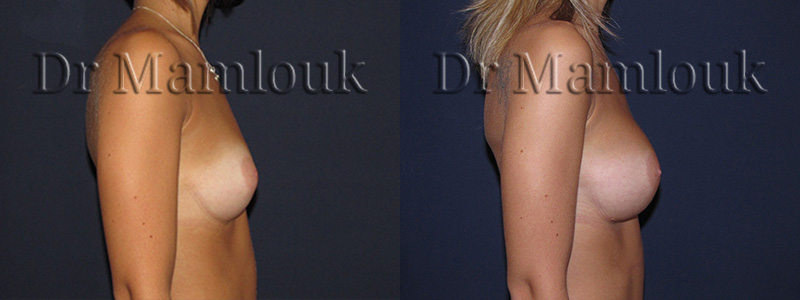 Augmentation mammaire par voie sous mammaire de prothèses rondes à profil modéré de 260 cc en position pré-musculaire - Docteur Mamlouk