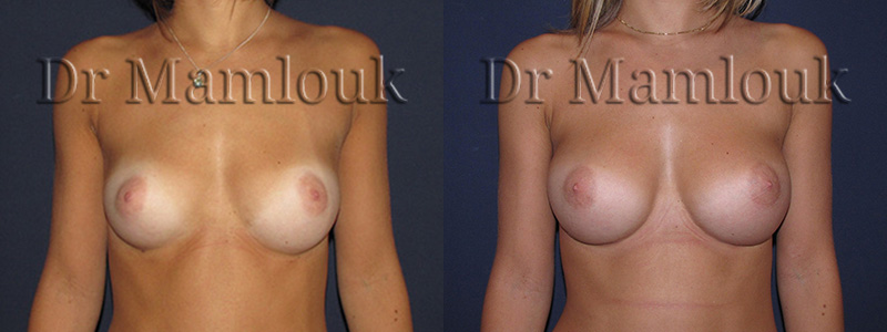 Augmentation mammaire par voie sous mammaire de prothèses rondes à profil modéré de 260 cc en position pré-musculaire - Docteur Mamlouk