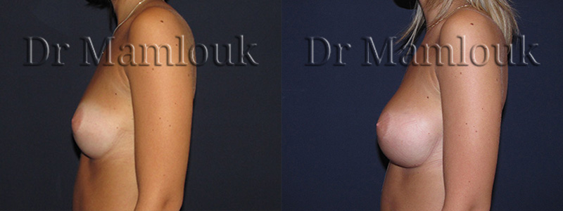 Augmentation mammaire par voie sous mammaire de prothèses rondes à profil modéré de 260 cc en position pré-musculaire - Docteur Mamlouk