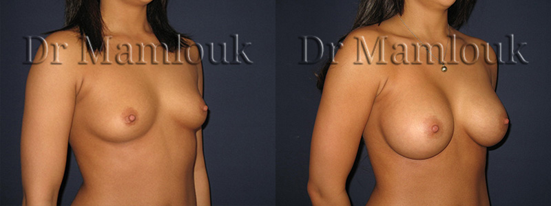 Augmentation mammaire par pose de prothèses à profil modéré de 310 gr à droite et 275 gr à gauche par voie axillaire en position rétro-musculaire.