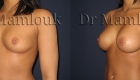 Augmentation mammaire par pose de prothèses à profil modéré de 310 gr à droite et 275 gr à gauche par voie axillaire en position rétro-musculaire.