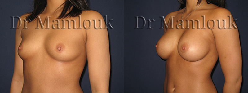 Augmentation mammaire par pose de prothèses à profil modéré de 310 gr à droite et 275 gr à gauche par voie axillaire en position rétro-musculaire.