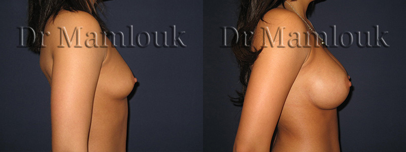 Augmentation mammaire par pose de prothèses à profil modéré de 310 gr à droite et 275 gr à gauche par voie axillaire en position rétro-musculaire.