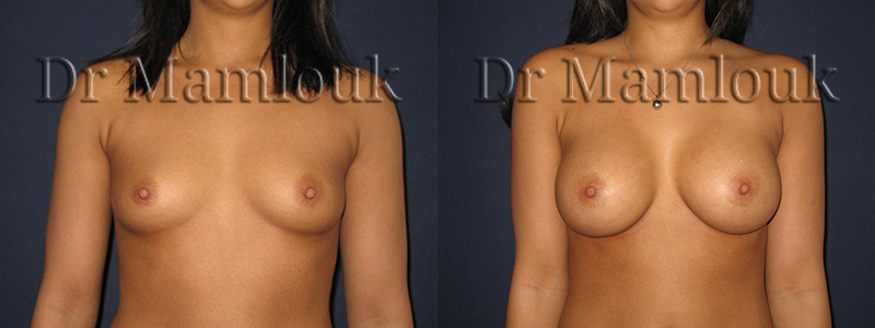 Augmentation mammaire par pose de prothèses à profil modéré de 310 gr à droite et 275 gr à gauche par voie axillaire en position rétro-musculaire.