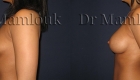 Augmentation mammaire par pose de prothèses à profil modéré de 310 gr à droite et 275 gr à gauche par voie axillaire en position rétro-musculaire.Augmentation mammaire par pose de prothèses à profil modéré de 310 gr à droite et 275 gr à gauche par voie axillaire en position rétro-musculaire.