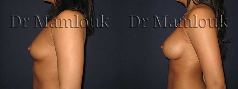 Augmentation mammaire par pose de prothèses à profil modéré de 310 gr à droite et 275 gr à gauche par voie axillaire en position rétro-musculaire.Augmentation mammaire par pose de prothèses à profil modéré de 310 gr à droite et 275 gr à gauche par voie axillaire en position rétro-musculaire.