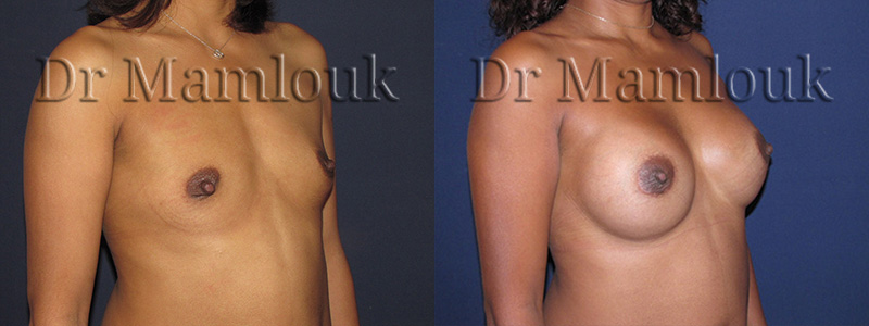 Augmentation mammaire par pose de prothèses rondes de 300 gr par voie aréolaire en position rétro-musculaire.