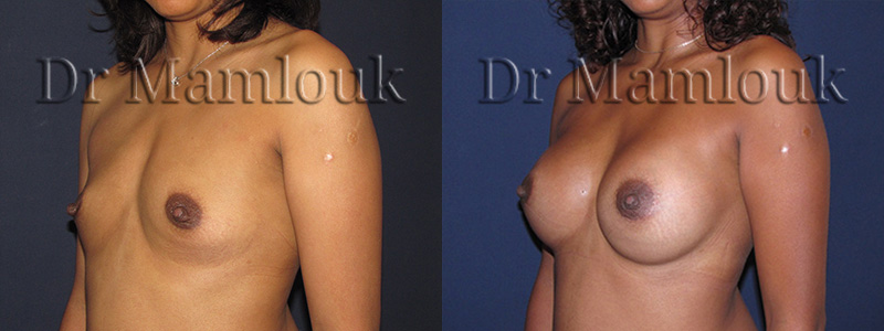 Augmentation mammaire par pose de prothèses rondes de 300 gr par voie aréolaire en position rétro-musculaire.