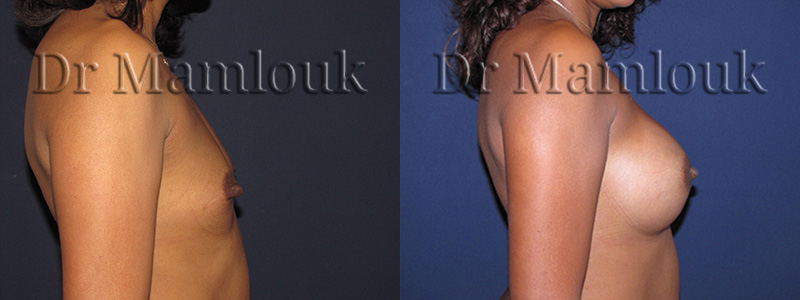 Augmentation mammaire par pose de prothèses rondes de 300 gr par voie aréolaire en position rétro-musculaire.