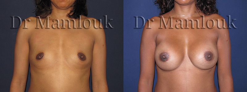 Augmentation mammaire par pose de prothèses rondes de 300 gr par voie aréolaire en position rétro-musculaire.