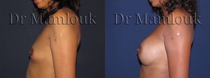 Augmentation mammaire par pose de prothèses rondes de 300 gr par voie aréolaire en position rétro-musculaire.