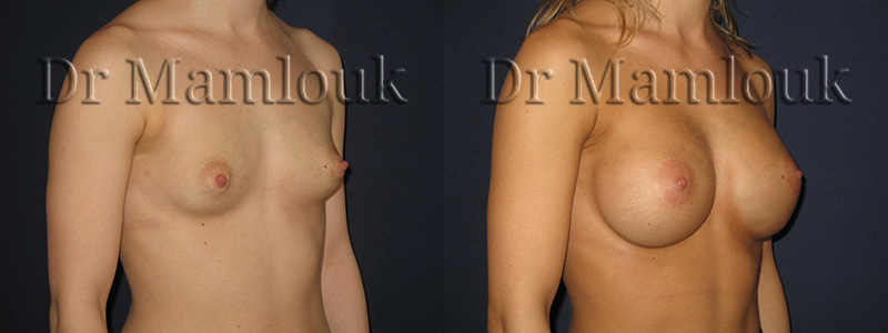 Pose de prothèses rondes de 345 cc à profil haut à droite et de 310 cc à profil modéré à gauche par voie aréolaire en position rétro-musculaire avec la technique de Dual Plan.