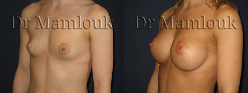 Pose de prothèses rondes de 345 cc à profil haut à droite et de 310 cc à profil modéré à gauche par voie aréolaire en position rétro-musculaire avec la technique de Dual Plan.