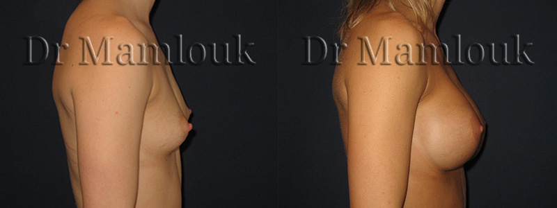 Pose de prothèses rondes de 345 cc à profil haut à droite et de 310 cc à profil modéré à gauche par voie aréolaire en position rétro-musculaire avec la technique de Dual Plan.