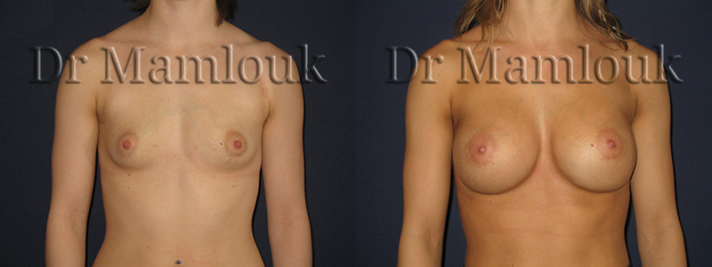 Pose de prothèses rondes de 345 cc à profil haut à droite et de 310 cc à profil modéré à gauche par voie aréolaire en position rétro-musculaire avec la technique de Dual Plan.