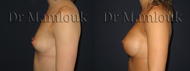 Pose de prothèses rondes de 345 cc à profil haut à droite et de 310 cc à profil modéré à gauche par voie aréolaire en position rétro-musculaire avec la technique de Dual Plan.