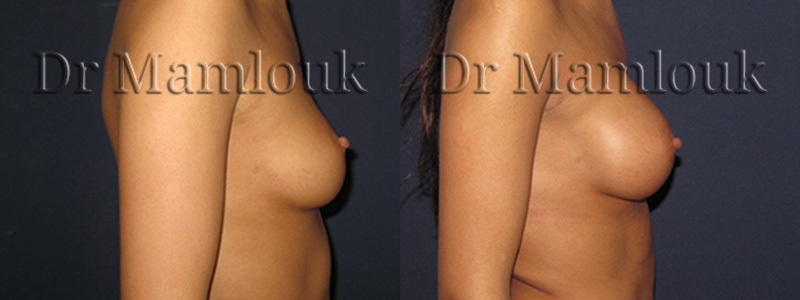 Pose de prothèses de 300 gr à profil modéré par voie axillaire en position rétro-musculaire avec la technique de Dual Plan.