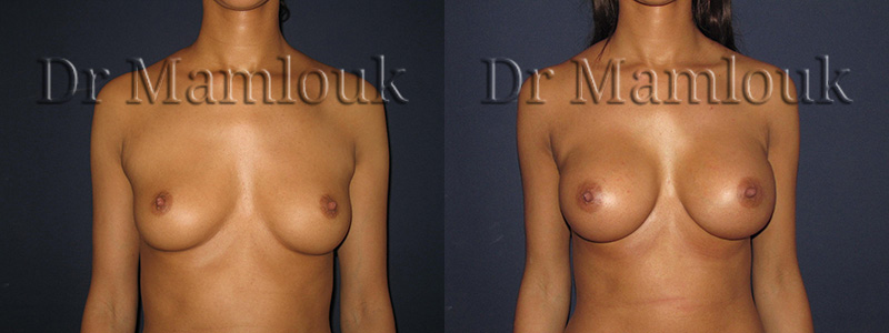 Pose de prothèses de 300 gr à profil modéré par voie axillaire en position rétro-musculaire avec la technique de Dual Plan.