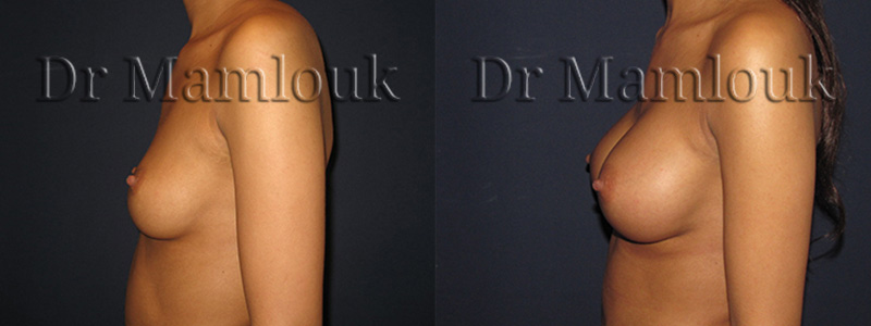 Pose de prothèses de 300 gr à profil modéré par voie axillaire en position rétro-musculaire avec la technique de Dual Plan.