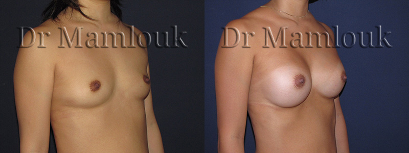 Augmentation mammaire par pose de prothèses rondes de 300 gr à profil modéré par voie aréolaire avec la technique de Dual Plan.