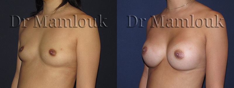 Augmentation mammaire par pose de prothèses rondes de 300 gr à profil modéré par voie aréolaire avec la technique de Dual Plan.