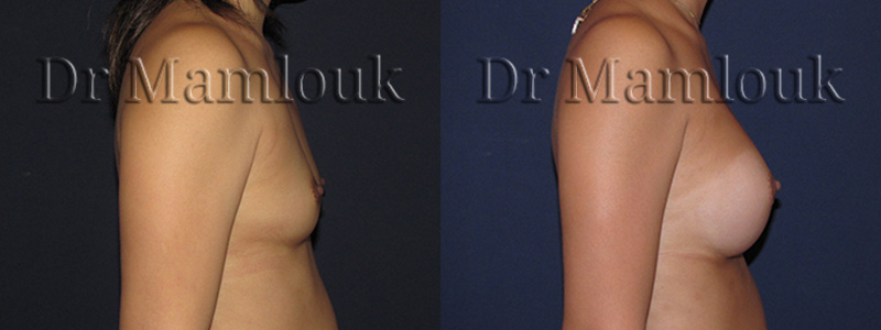 Augmentation mammaire par pose de prothèses rondes de 300 gr à profil modéré par voie aréolaire avec la technique de Dual Plan.